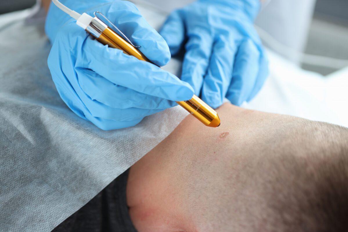 Laser Tattoo Removal Doctor in Jaipur