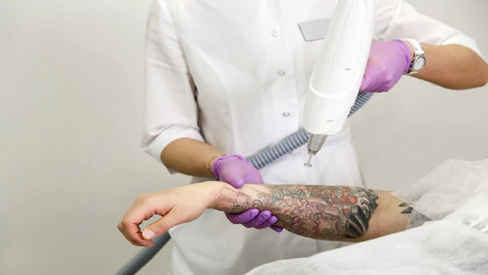tattoo-removal-laser treatment in jaipur