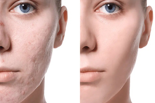 Acne Scar Treatment in Jaipur
