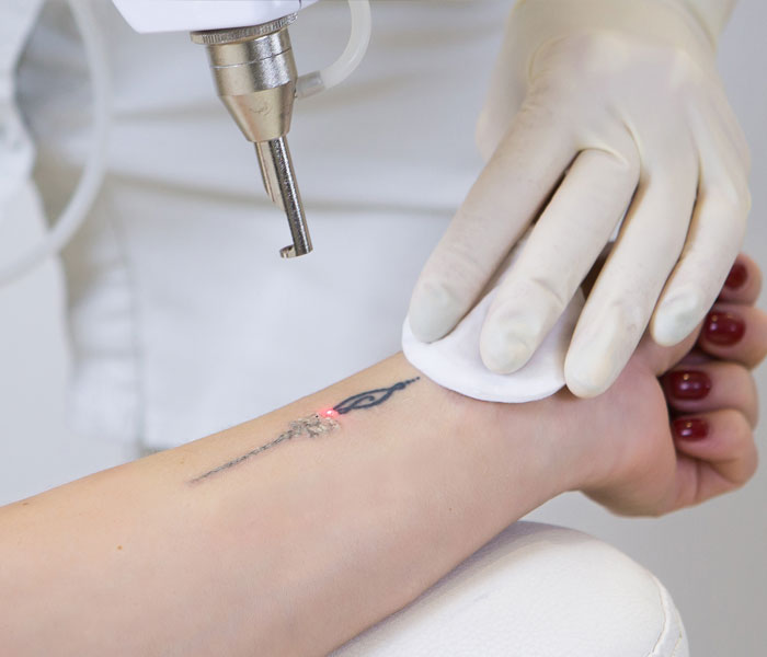 Laser Tattoo Removal in Jaipur