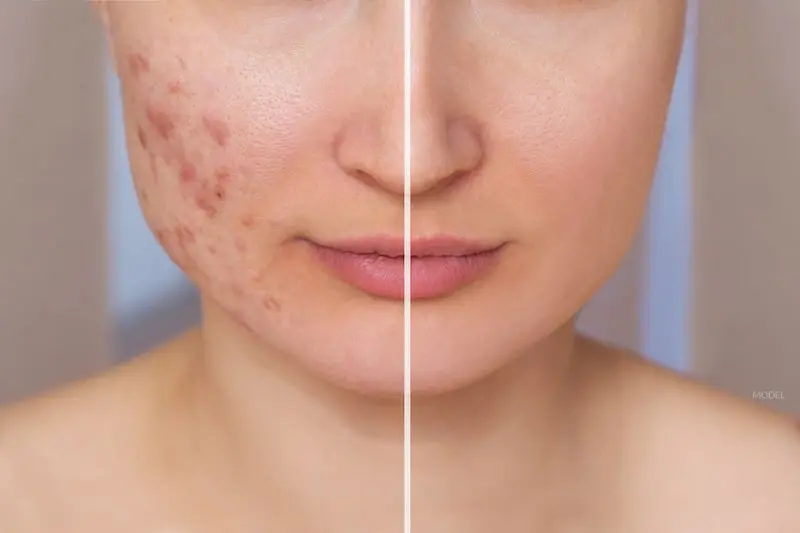 Acne Scar Treatment in Jaipur